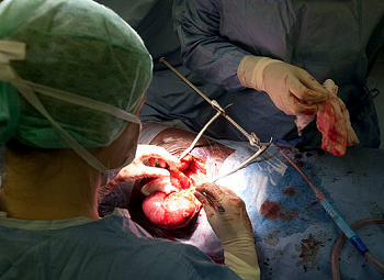 Kidney Transplant Operation